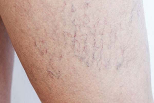 British Varicose Vein Centre Treatment For Varicose Veins And Other