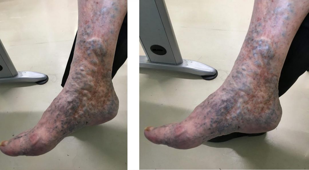 Operations On Veins / Stripping British Varicose Vein Centre